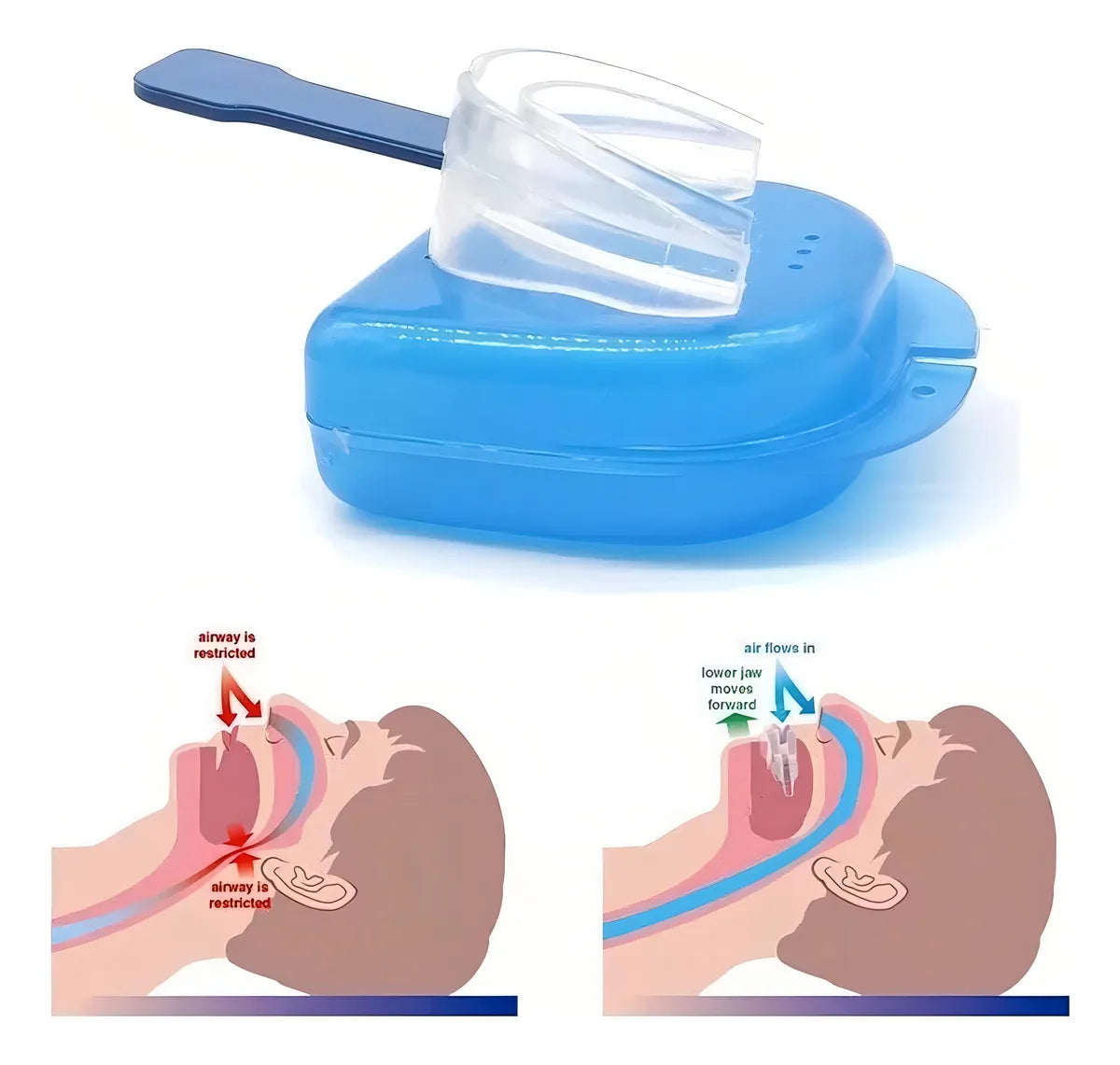 Placa Anti bruxismo Apnea y ronquido